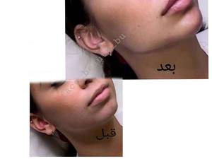 زاویه سازی در بوشهر مطب زیبایی