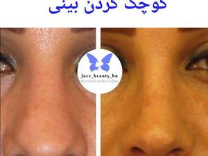 کوچک کردن بینی بدون عمل جراحی در بوشهر