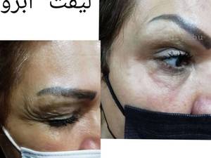 لیفت ابرو  با نخ در بوشهر