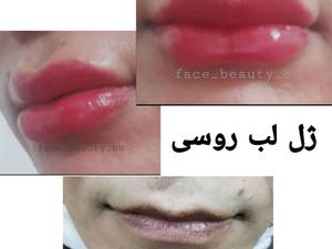 ژل لب روسی در کلینیک پوست و زیبایی فیس بیوتی بوشهر