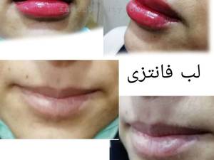 ژل لب روسی در کلینیک پوست و زیبایی فیس بیوتی بوشهر