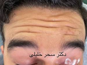بوتاکس پیشانی در یزد