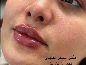 حجم دادن به لب ها به صورت حرفه ای در یزد