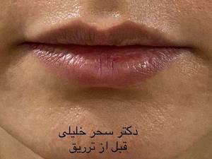 حجم دادن به لب ها به صورت حرفه ای در یزد