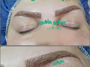 انجام میکرو پیگمنتیشن