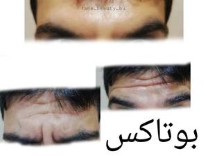 انجام بوتاکس  در بوشهر