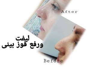 لیفت ورفع قوز بینی در بوشهر
