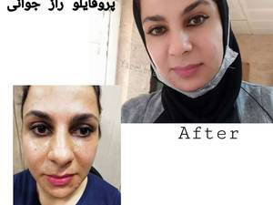 پروفایلو راز جوانی