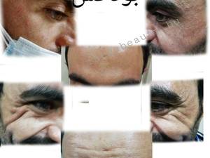 بهترین بوتاکس در بوشهر