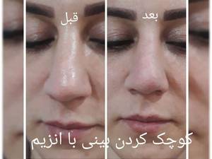 تزریق انزیم به صورت حرفه ای در  در تهران