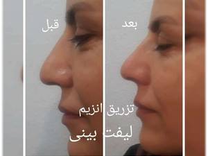 تزریق انزیم به صورت حرفه ای در  در تهران