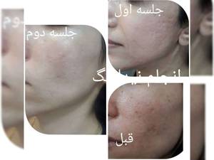 اجرا میکرو نیدلینگ  لایه بردار در تهران