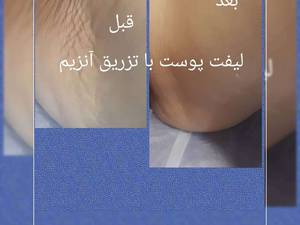 از بین بردن چروک پوستی در تهران