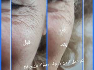 از بین بردن چروک صورت با تزریق تخ های کلاژن ساز