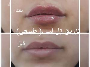 تزریق نیم سی سی ژل لب در تهران