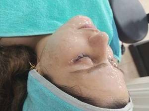 پاکسازی انواع  پوست  در لنگرود