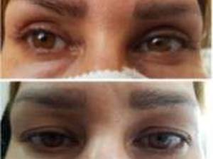 جراحی افتادگی پلک  در شیراز