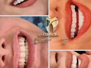 هزینه هر واحد کامپوزیت ونیر سرامیکی  در تهران
