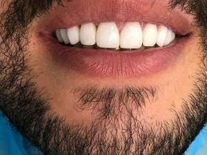 هزینه کامپوزیت فک بالا در ماهشهر