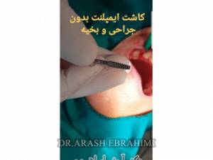 کاشت ایمپلنت بدون جراحی و بخیه