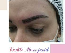 کاشت ابرو به صورت کاملا تخصصی در شیراز
