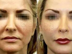 ادغام نخ لیفت با تزریق فیلر(لیفتینگ&تزریق ژل)