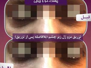 تزریق مزو ژل زیر چشم(بلافاصله پس از تزریق)