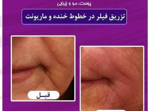 تزریق فیلر در خطوط خنده و ماریونت
