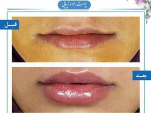 تزریقات ژل لب
