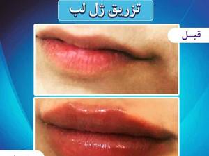 تزریقات ژل لب