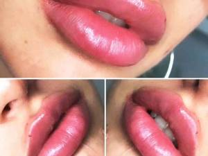 تزریق ژل لب  در رشت