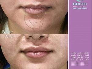 تزریف ژل لب با حجم کم وطبیعی