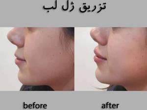 تزریق ژل لب به منظور لیفت و افزایش حجم بافت لب