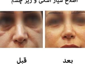 اصلاح شیار اشکی و زیر چشم
