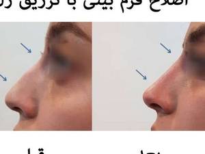 اصلاح فرم بینی