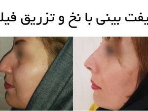 لیفت بینی