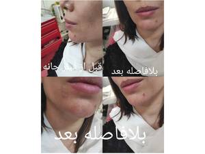 فیلر چانه