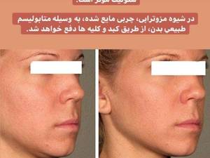مرکز مزوتراپی غبغب