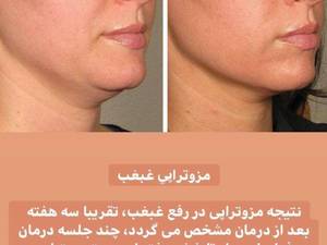 مرکز مزوتراپی غبغب