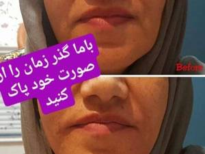 مرکز تزریق فیلر و محو کردن خط خنده به صورت تخصصی