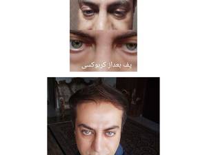کربوکسی تراپی زیر چشم