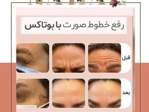 از بین بردن چروک دور چشم و پیشانی در تهران