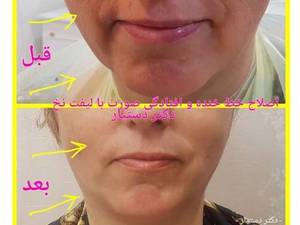 اصلاح خط خنده و افتادگی صورت با لیفت نخ