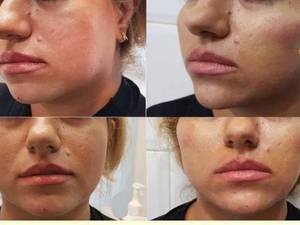 ایجاد خط گونه با تزریق فیلر