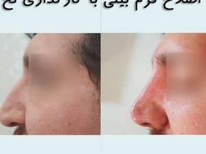 اصلاح فرم بینی با نخ