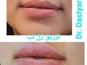 تزریق ژل لب
