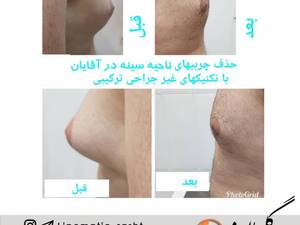 حذف چربی های اضافه