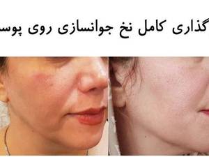 اثرگذاری کامل نخ های جوانسازی