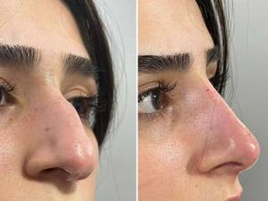 اصلاح فرم بینی بدون جراحی در تهران