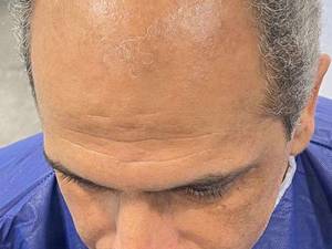 کاشت پرتراکم مو در سعادت آباد